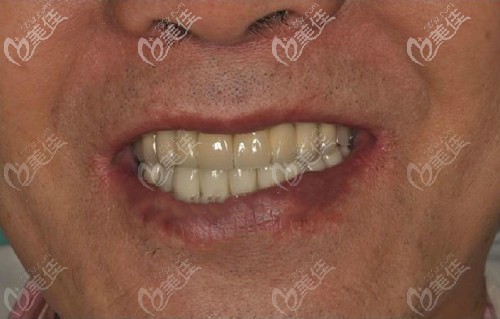 南充美昂口腔全口種植牙后的效果