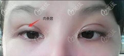 肉條和腫的區(qū)別圖片