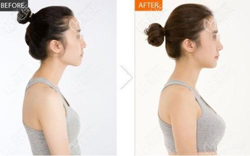 武漢<!--<i data=20240703-sp></i>-->任玉萍醫(yī)生假體隆胸案例 武漢<!--<i data=20240703-sp></i>-->任玉萍醫(yī)生假體隆胸案例