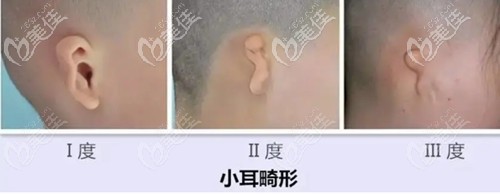 小耳畸形的程度
