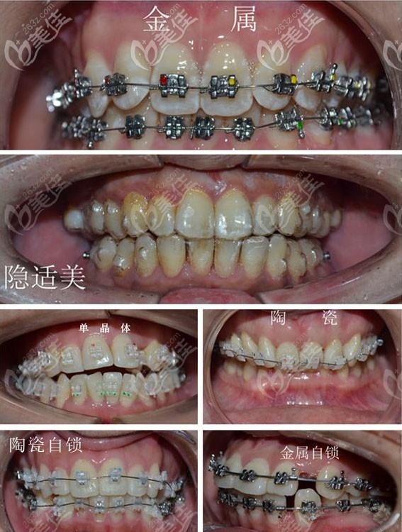 陶瓷自鎖、金屬自鎖、隱形牙套區(qū)別示意圖