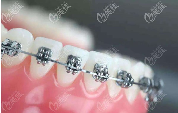 上門牙外突戴哪種牙套效果好 上門牙外突戴哪種牙套效果好
