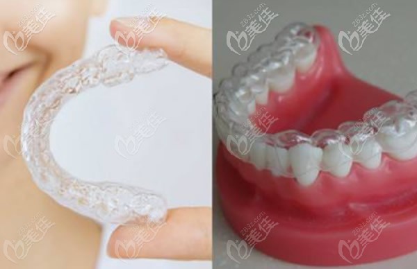 無托槽透明隱形牙套 無托槽透明隱形牙套