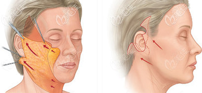 柳京翰面部提升手術(shù)的示意圖 柳京翰面部提升手術(shù)的示意圖