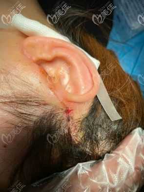 耳朵處的切口 耳朵處的切口
