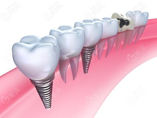 陳青龍醫(yī)生科普不同品牌種植體的特色