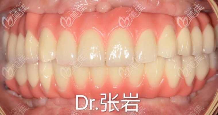 allon6種植牙效果圖