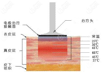 電波拉皮除皺原理示意圖
