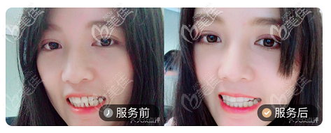北京壹加壹口腔正畸案例對比圖
