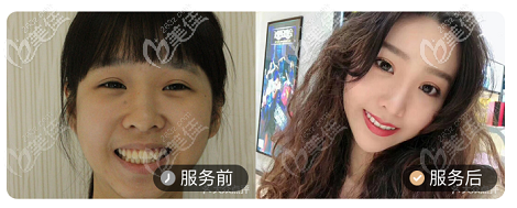 北京壹加壹口腔齙牙矯正案例