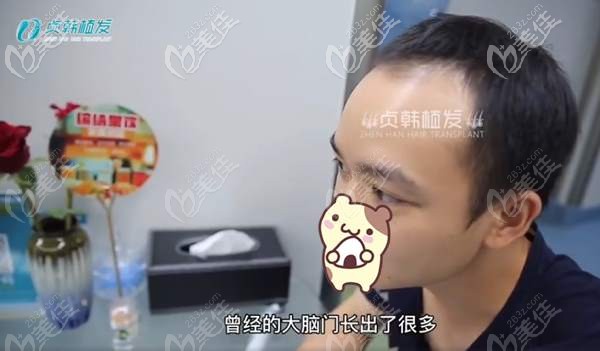 植發(fā)前前額脫發(fā)明顯 植發(fā)前前額脫發(fā)明顯