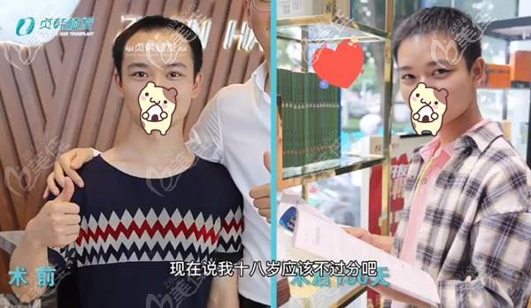 他在玉林貞韓前額發(fā)際線種植3500毛囊單位的3個月后,說失而復(fù)得太開心了