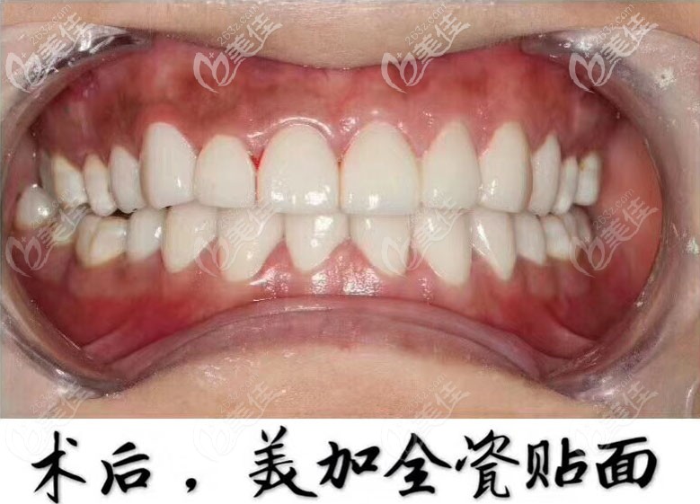 趁廣州壹加壹口腔價格優(yōu)惠時做美加超薄全瓷貼面，矯正美白二合一