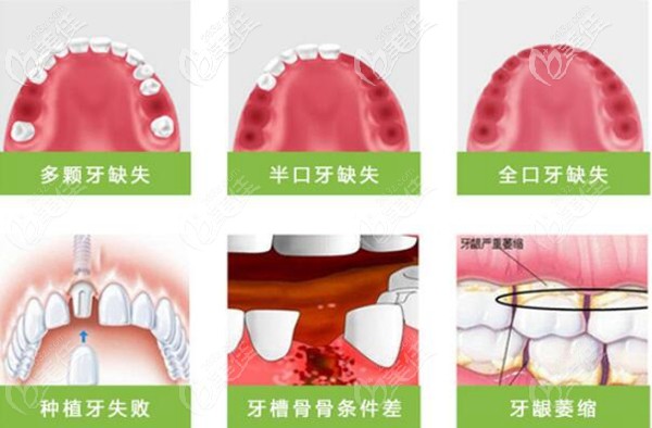 種植牙適合的種植人群 種植牙適合的種植人群