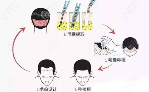 吳醫(yī)生做發(fā)際線移植手術原理 吳醫(yī)生做發(fā)際線移植手術原理