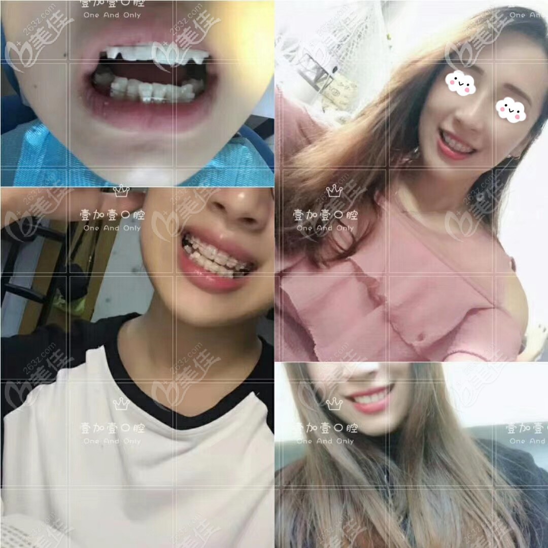 廣州壹加壹半隱形陶瓷矯正案例對(duì)比圖