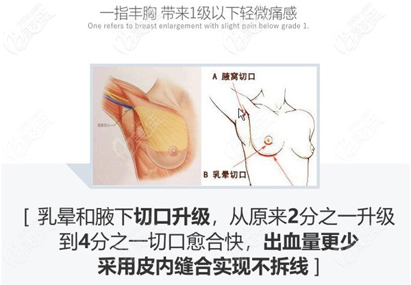 假體隆胸疼痛感低，出現(xiàn)少