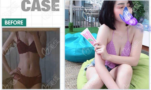 曼托假體隆胸案例前后對比效果