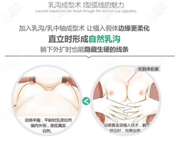 假體豐胸乳溝自然生動