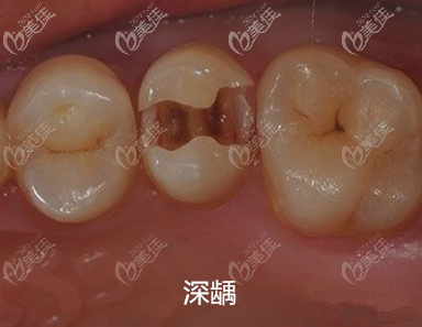 深齲圖 深齲圖