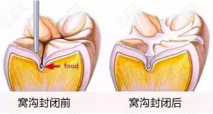 窩溝封閉治療前后對比 窩溝封閉治療前后對比