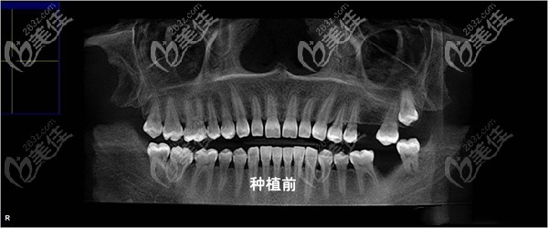 做種植牙之前的照片 做種植牙之前的照片