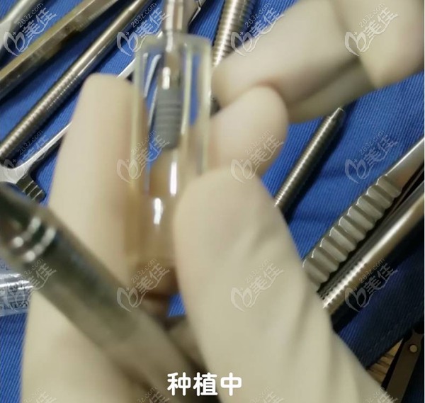 做瑞士ITI種植牙過(guò)程 做瑞士ITI種植牙過(guò)程