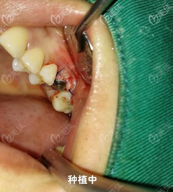做瑞士ITI種植牙手術(shù)中 做瑞士ITI種植牙手術(shù)中