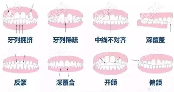 可以做牙齒矯正的牙齒類(lèi)型