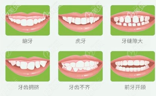 時(shí)代天使隱形矯正的項(xiàng)目 時(shí)代天使隱形矯正的項(xiàng)目