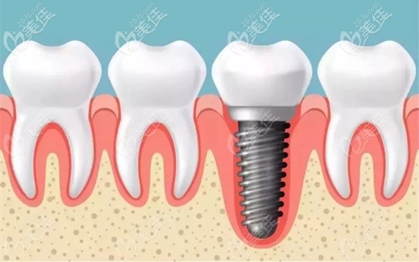 寮步莞大口腔的美國皓圣種植牙參考價(jià)格 寮步莞大口腔的美國皓圣種植牙參考價(jià)格