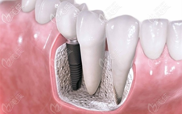 東莞莞大口腔的瑞士ITI種植牙參考價(jià)格 東莞莞大口腔的瑞士ITI種植牙參考價(jià)格