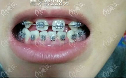 已經(jīng)戴牙套二百多天了 已經(jīng)戴牙套二百多天了