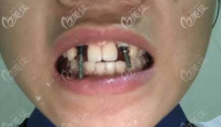 我做的是瑞士ITI種植體 我做的是瑞士ITI種植體