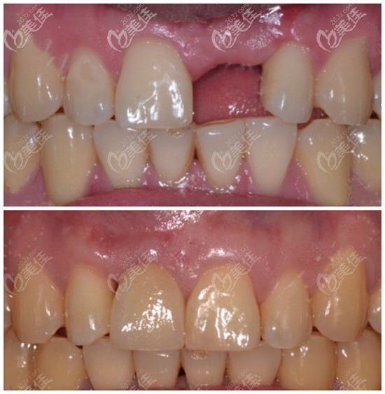 進口種植牙選德國camlog種植體的優(yōu)缺點及價格,你想知道的都在這里了