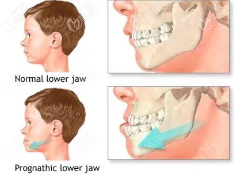 兒童地包天牙齒突出示意圖 兒童地包天牙齒突出示意圖