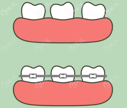 兒童地包天矯正帶牙套示意圖 兒童地包天矯正帶牙套示意圖