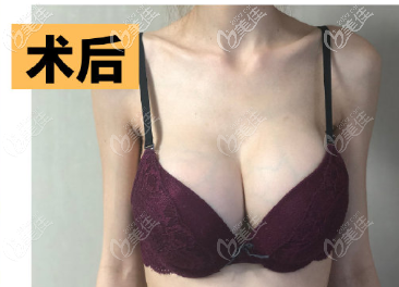 金祐正醫(yī)生給我做魔滴假體隆胸一個(gè)月效果