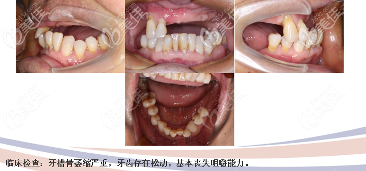 4顆半口諾貝爾種植牙術(shù)前圖片 4顆半口諾貝爾種植牙術(shù)前圖片