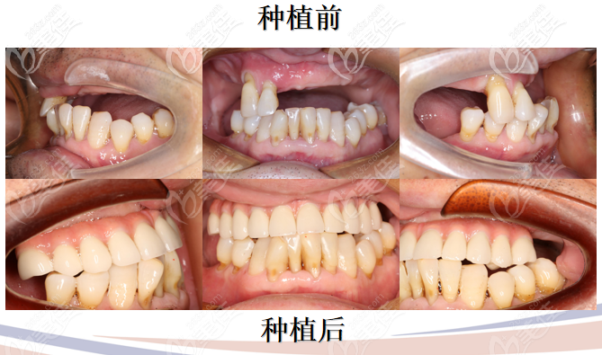種植前后對比照片 種植前后對比照片