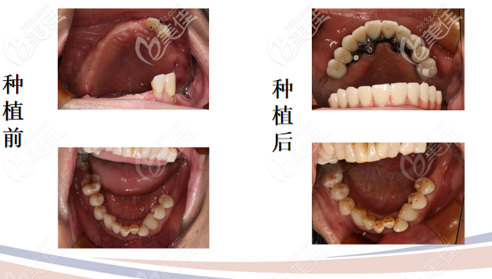 4顆半口諾貝爾種植牙圖片（來自一位60多歲的老人）