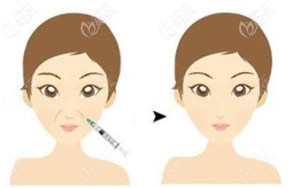 法令紋注射的效果 法令紋注射的效果