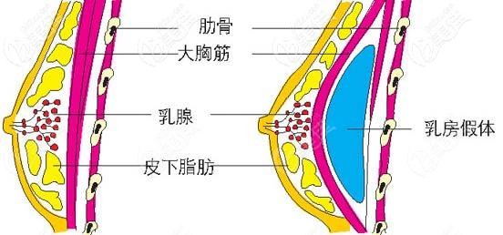 隆胸假體的置放位置 隆胸假體的置放位置
