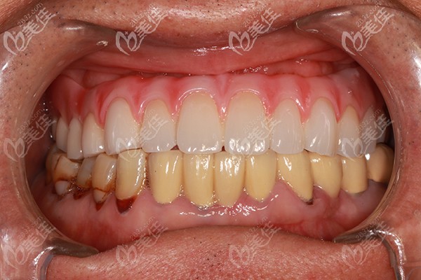 帶著老爸體驗(yàn)了一把登騰allon4上半口種植牙后,他現(xiàn)在吃嘛嘛香