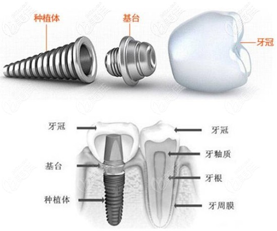 瑞士ITI種植體 瑞士ITI種植體