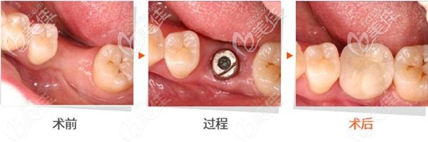 去年在深圳光美口腔做了一顆瑞士ITI種植牙，真心覺得選擇好植體就是不一樣