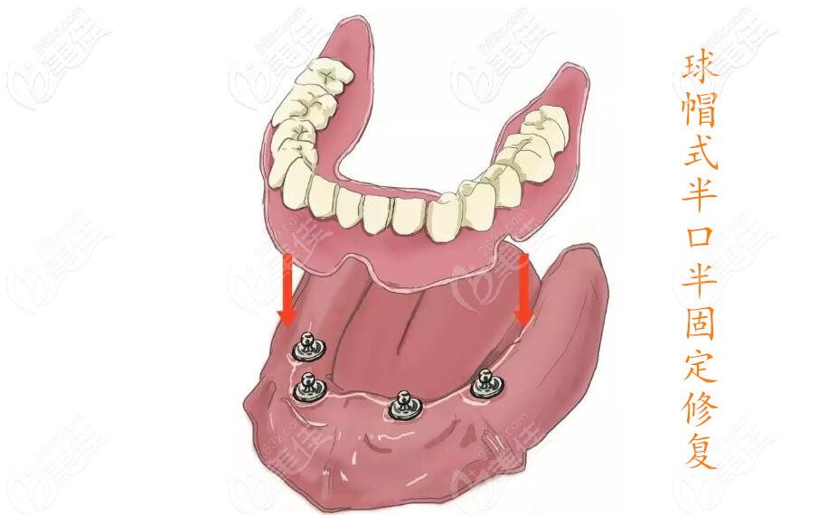 半口半固定球帽式修復(fù) 半口半固定球帽式修復(fù)