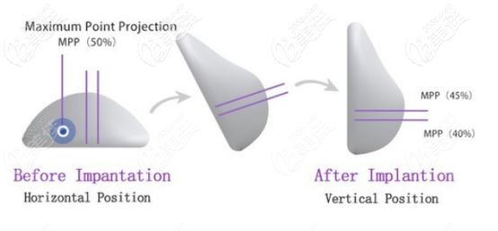魔滴假體的形狀 魔滴假體的形狀