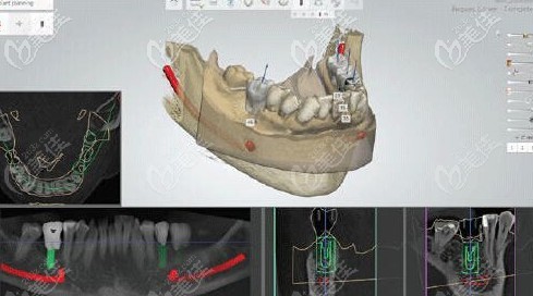 采集數(shù)據(jù)設(shè)計(jì)種植牙導(dǎo)板