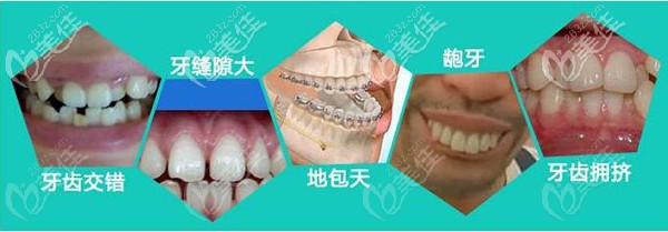 3M金屬托槽能解決的問(wèn)題